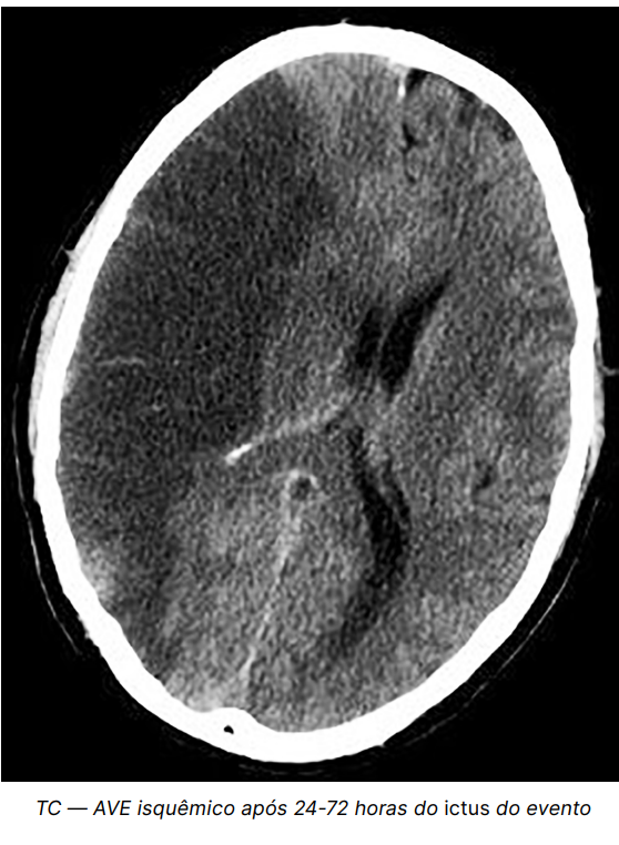 TC — AVE isquêmico após 24-72 horas do ictus do evento