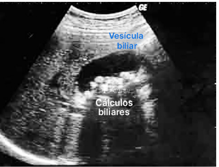 cálculos biliares na USG observe a sombra acústica