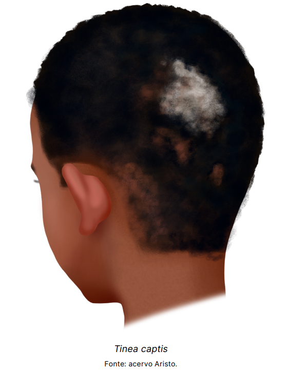 2.a. Tinea Captis