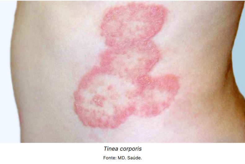 3.a. Tinea corporis
