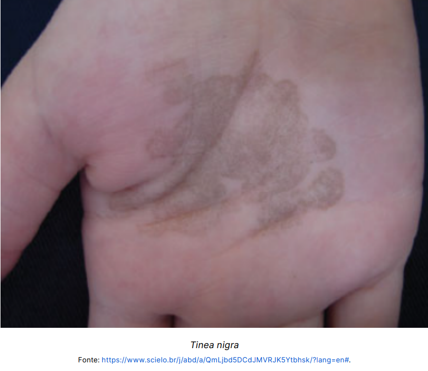 4.a. Foto de introdução tinea nigra